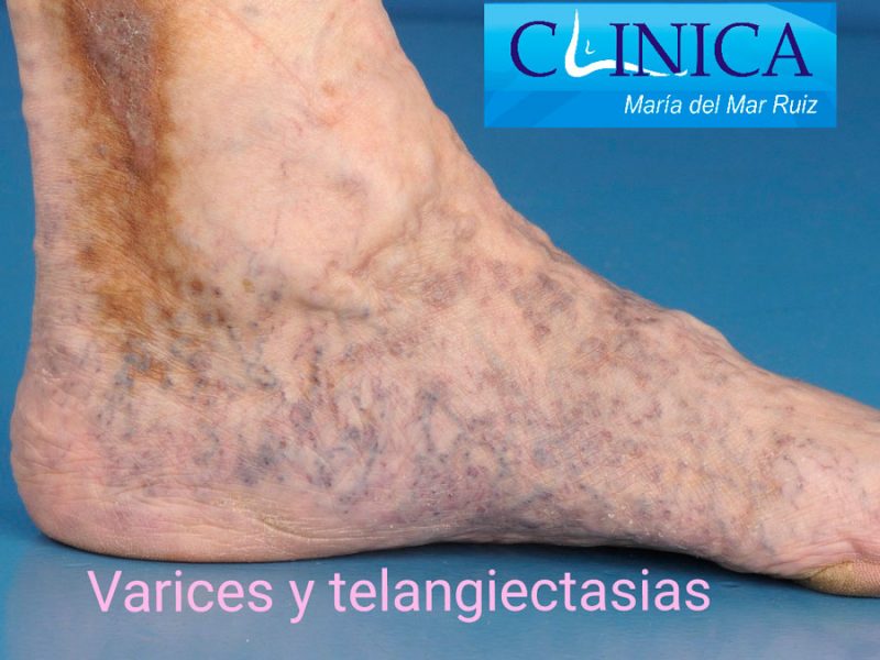 Varices Y Telangiectasias Escleroterapia