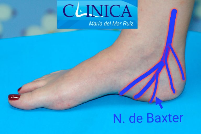 Neuropat A O S Ndrome De Baxter Causas S Ntomas Y Tratamiento