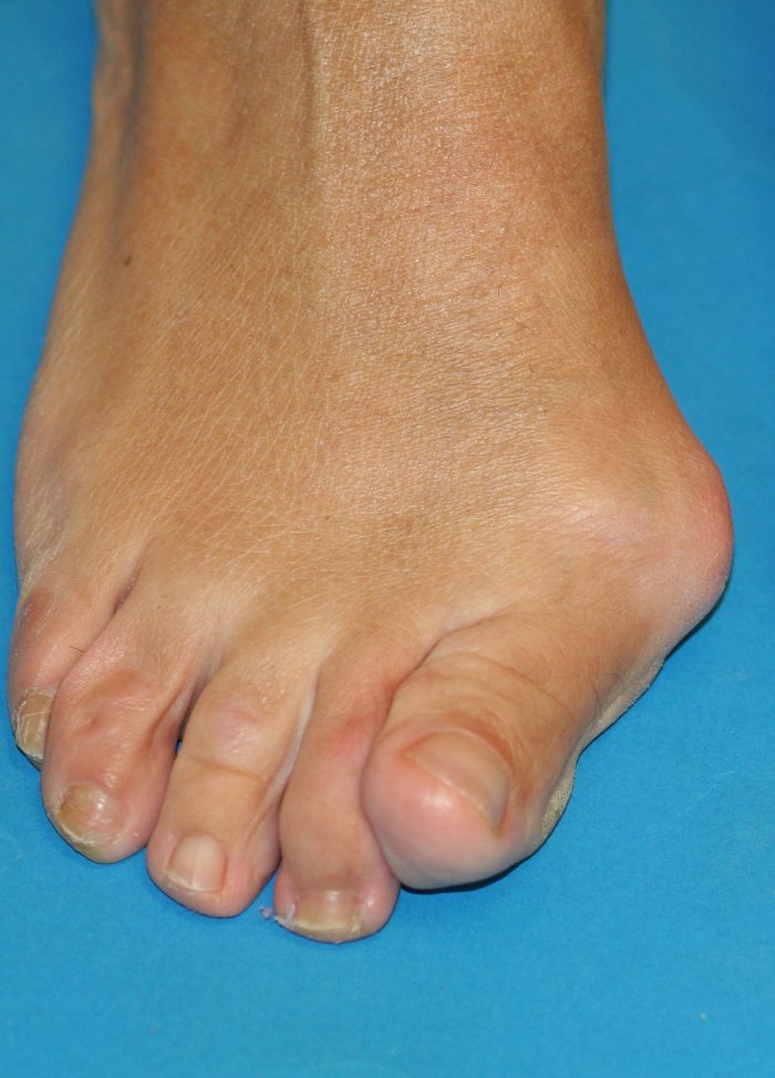 Hallux Valgus O Juanete 6 Clínica María Del Mar Ruiz 7116