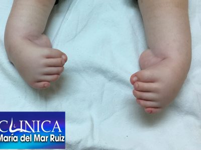 Bebé con deformidad severa de tobillo y pie Cirugía-Reconstructiva-de-Tobillo-y-Pie