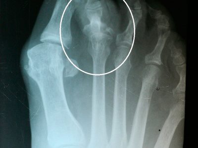 Dedos-en-martillo-y-dedos-en-garra Luxación metatarsofalángica de un dedo en martillo
