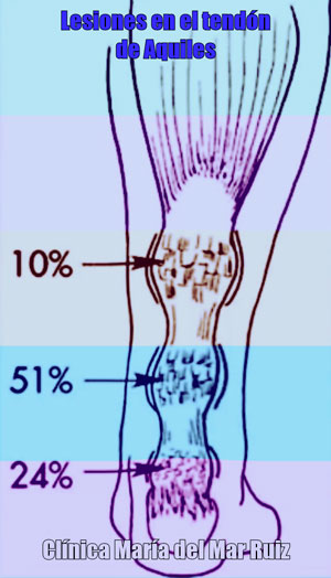 Porcentajes en la localización de las lesiones del tendón de aquiles Tendinopatía-Tendón-de-Aquiles