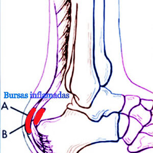 Bursitis pre y retroaquileas. Estas bursitis producen mucho dolor en la parte posterior del talón.