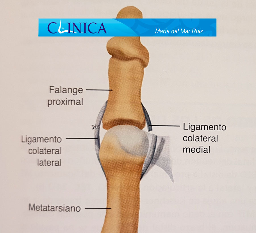 Rotura del ligamento colateral produciendo desviación de la articulación metatarsofalángica