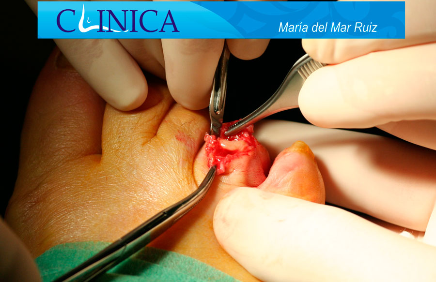 Cirugías correctivas para el dedo infra y supraducto bajo anestesia local