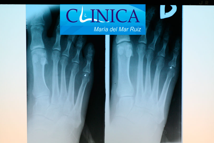 Radiografías con un testigo para comprobar la coincidencia de una lesión en la piel de la planta del pie, con la cabeza del quinto metatarsiano