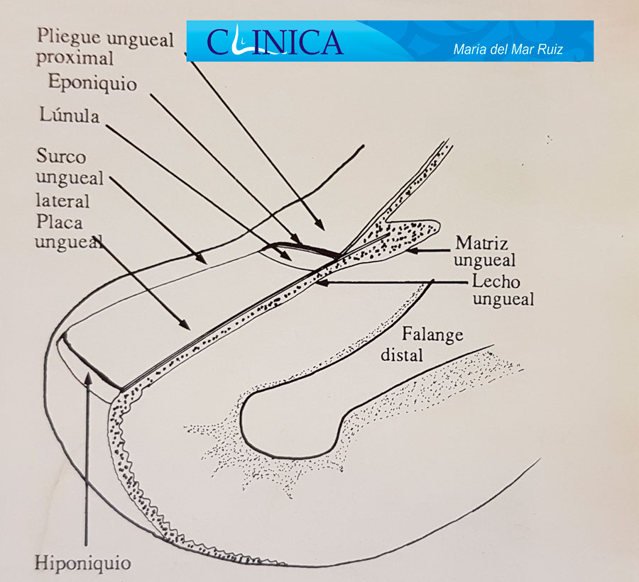 Anatomía de la unidad de la uña Uña-encarnada-u-Onicocriptosis