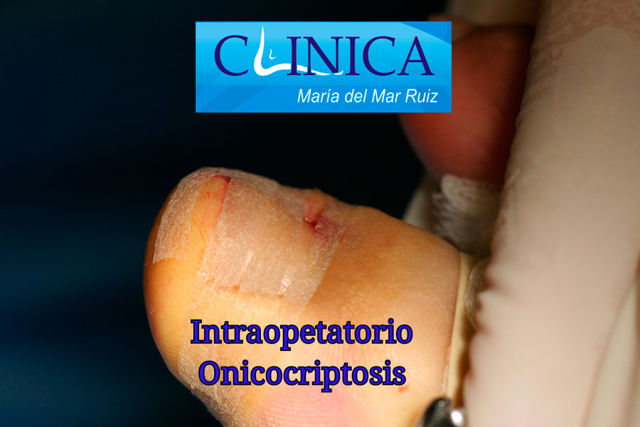 Uña-encarnada. Imágenes intraoperatorias y vendaje posterior en la cirugía de la uña: el paciente se va caminando.