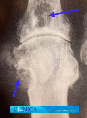 sintomas de la artropatia-gotosa-y-pseudogota