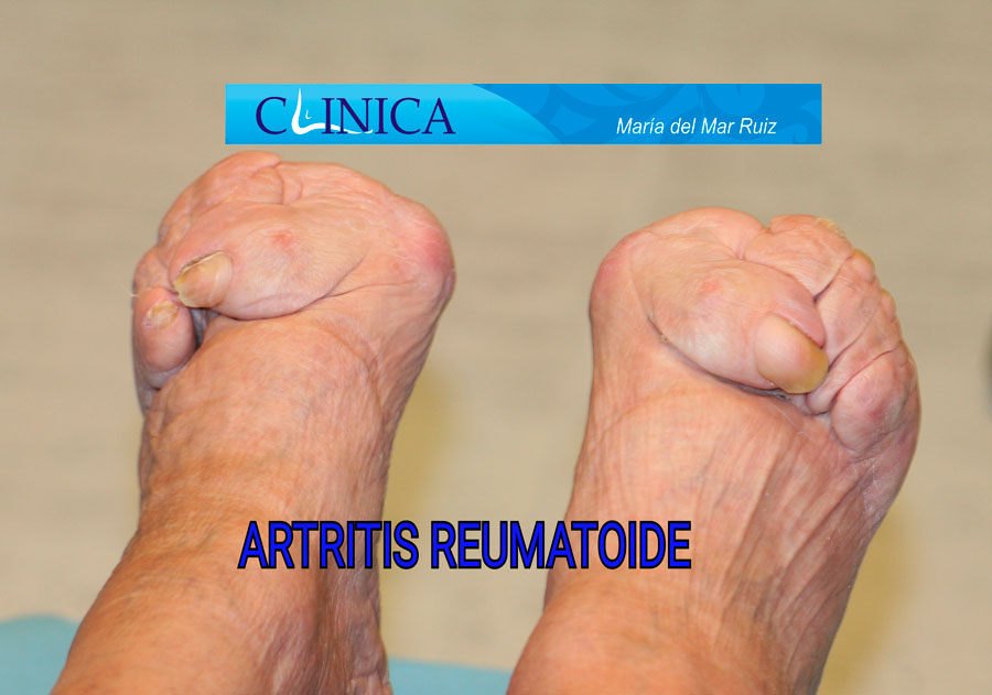 pie-reumatico-y-artritis-reumatoide
