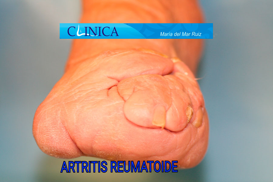 Deformidad de antepié por artritis reumatoide