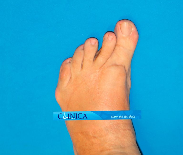 Pie Reumático Artritis Reumatoide