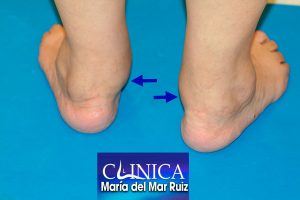 Pie Reumático Artritis Reumatoide