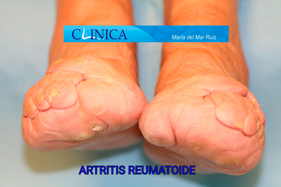 Deformación severa por artritis reumatoide de todos los dedos del pie