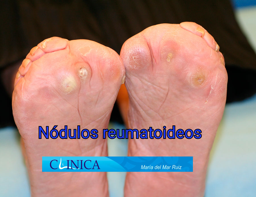 Callosidades y nódulos reumatoideos en la planta de un paciente con artritis reumatoide