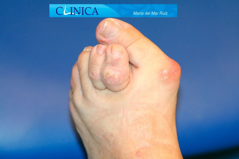 Pie Reumático Artritis Reumatoide