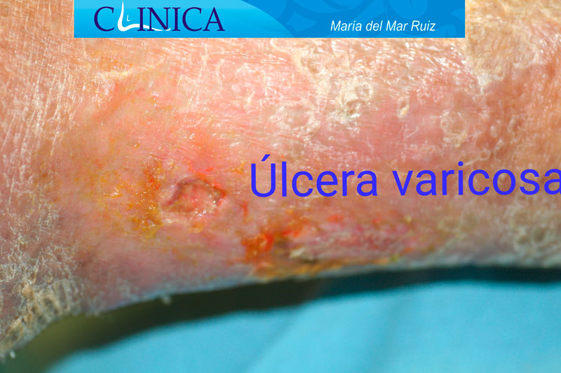 Las úlceras varicosas pueden causar mucho dolor