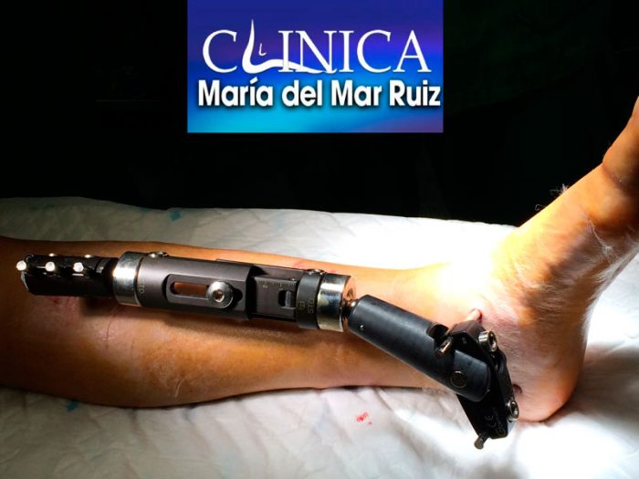 Fractura del quinto metatarsiano. Qué es, causas, síntomas y tratamiento