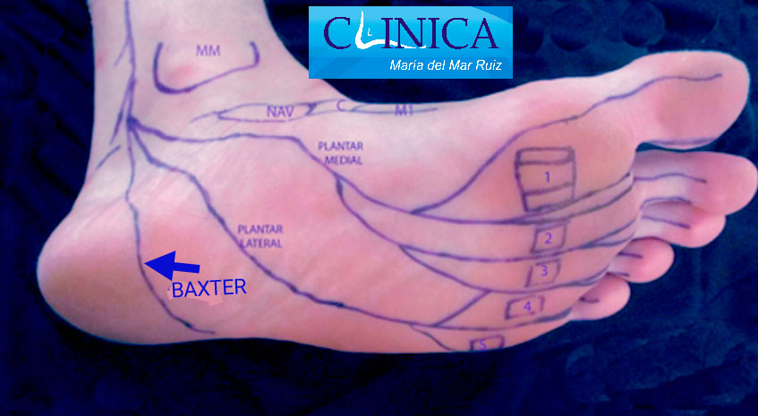 Nervio tibial posterior y las ramas habituales en la planta del pie Neuropatía-de-Baxter