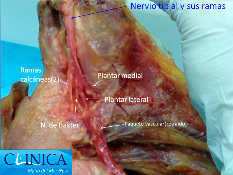 Anatomía topográfica del nervio de Baxter, nervio tibial y sistema vascular(retraído)