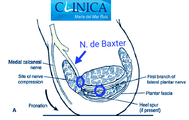 La pronación es un factor biomecánico de neuropatía de Baxter. Las plantillas ortopodológicas a medida son un buen tratamiento en estos casos