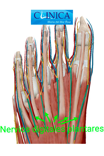 Nervios digitales dorsales y plantares: los neuromas son más habituales en los plantares, en especial en el 3º interespacio