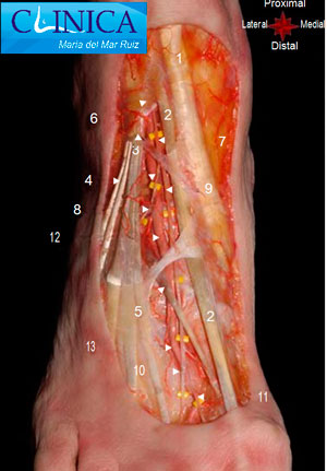 dolor del nervio fibular