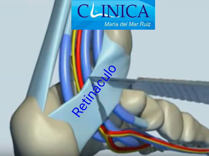 Cirugía del túnel del tarso: liberación del retináculo flexor