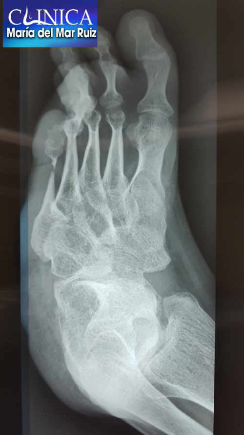 Radiografía dorsoplantar en carga: gran deformidad de un pie equino varo ya estructurado de un niño sin tratar