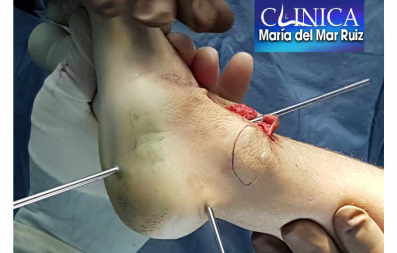 Pasos quirúrgicos de una de las técnicas en la corrección del pie equino varo