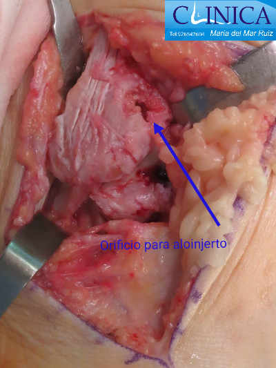 En la reparación anatómica a veces se utilizan aloinjertos para reforzar los ligamentos dañados