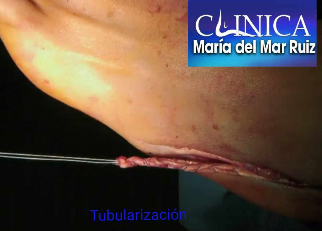 Reparación quirúrgica del tendón mediante tubularización