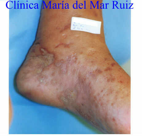 Sarcoma de Kaposi (Tumores Óseos y de partes blandas del tobillo y pie) antes y después de tratamiento con Flores de Bach.