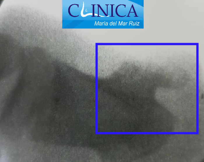 Radiografía con osteocondroma en la falange distal del dedo. Tumores Óseos y de partes blandas del tobillo y pie
