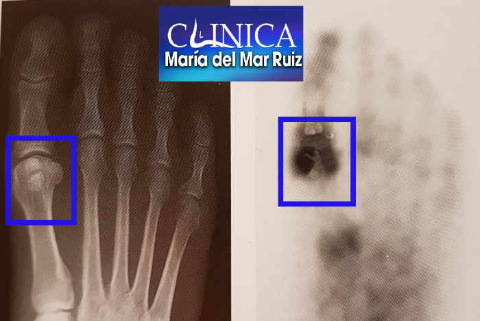 La Radiografía y la Gammagrafía son pruebas de imagen para valorar los tumores en pie y tobillo
