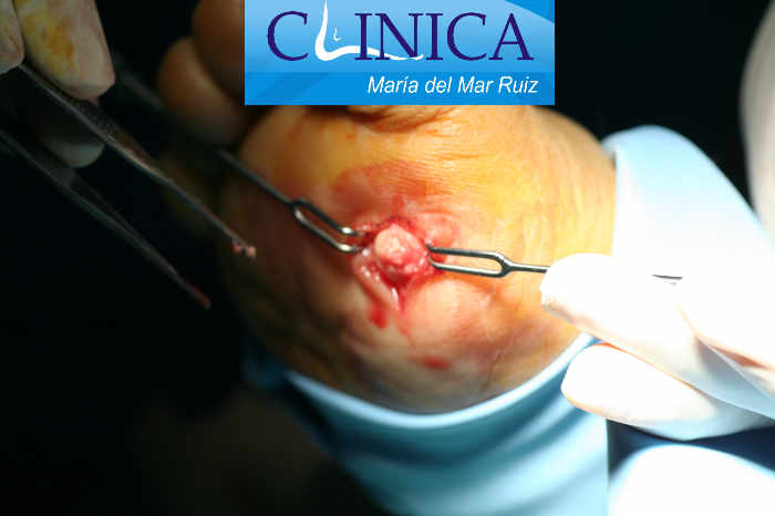 Biopsia de tumores oseos y de partes blandas de pie y tobillo por escisión: secuencia intraoperatoria de los pasos quirúrgicos para su extirpación