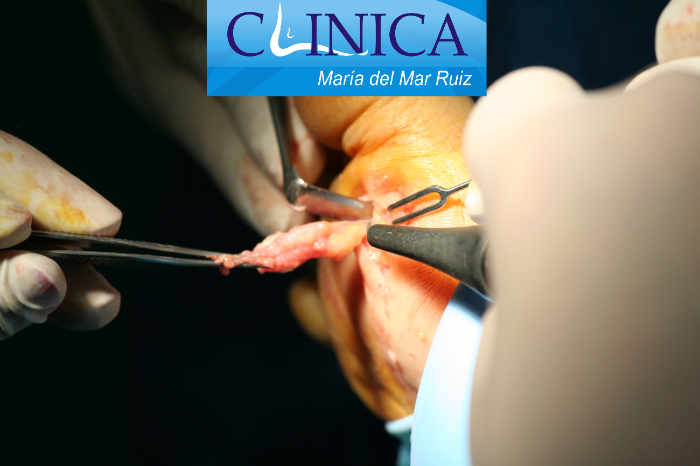Biopsia de tumores oseos y de partes blandas de pie y tobillo por escisión: secuencia intraoperatoria de los pasos quirúrgicos para su extirpación