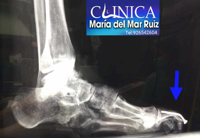 Paciente intervenido de pie cavo con Ataxia de Friedreich: la deformidad que es progresiva tiene tal fuerza muscular que ha doblado el tornillo colocado 4 años antes
