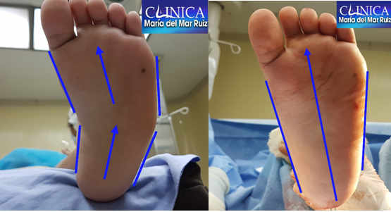 Antes y después de la cirugía para corregir la aducción del antepié en un pie cavo