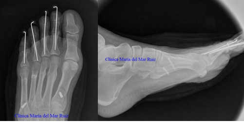 Radiografías intraoperatorias: osteotomías dorsiflexoras y corrección de dedos en martillo