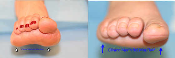 Corrección quirúrgica de pie cavo anterior: antes de la cirugía dedos en martillo y luxación de los metatarsianos que han quedado alineados después.