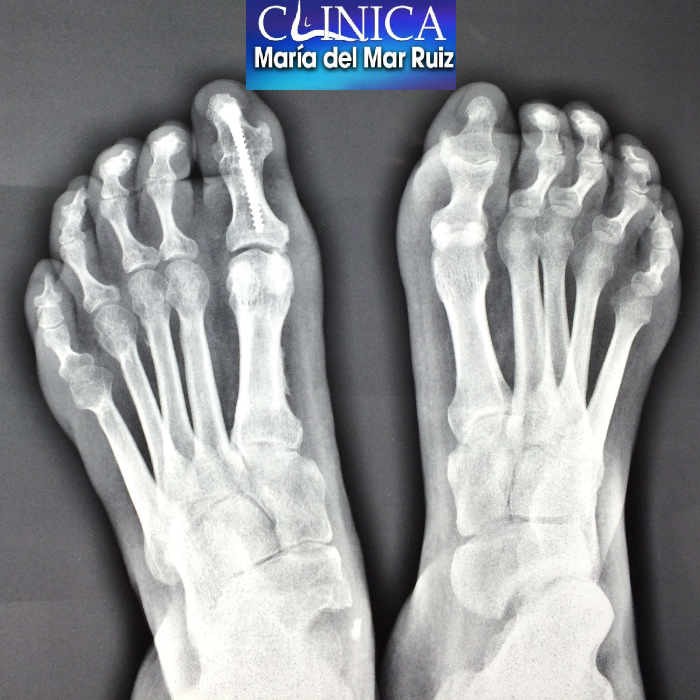 Radiografía de paciente con pie cavo afectado de la enfermedad de Charcot-Marie-Tooth