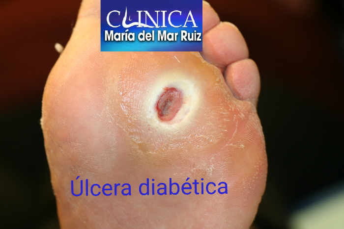 Úlcera en un pie diabético por pérdida de sensibilidad