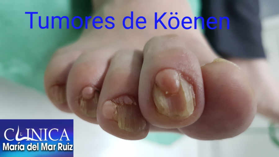 tumor de Köenen en las uñas de los pies
