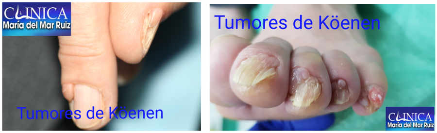 tumor de Köenen en las uñas de los pies