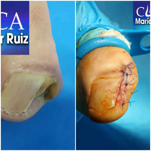 Cirugía del pie