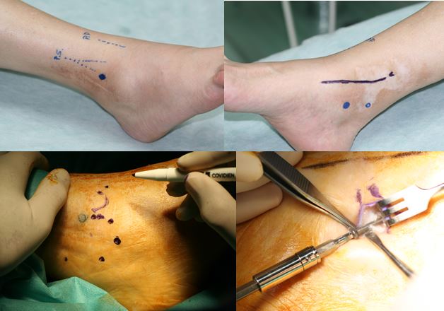 mapero ecográfico previo a la cirugía de tobillo permite realizar incisiones más pequeñas y no dañar vasos o nervios adyacentes,