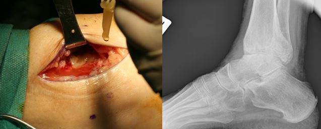 Radiografía posperatoria de una una cirugía por dolor de tobillo tras una fractura