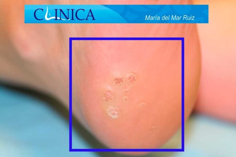 Verruga Plantar o Papiloma Verruga Plantar o Papiloma
