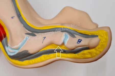 compresión nerviosa en el pie por neuroma